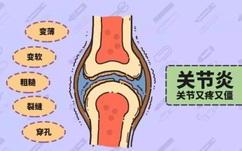 为何女性骨关节炎是男性3倍？