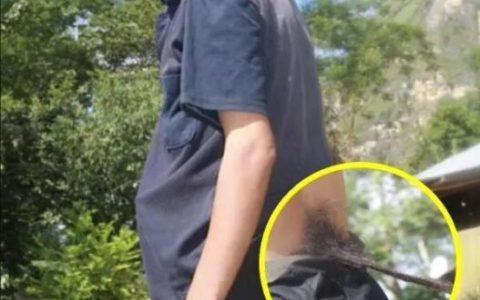 越南有位男人身后长有黑色“尾巴”,每次只要一剪掉就会生病