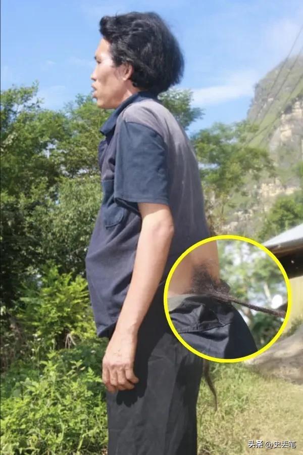 越南有位男人身后长有黑色“尾巴”，每次只要一剪掉就会生病