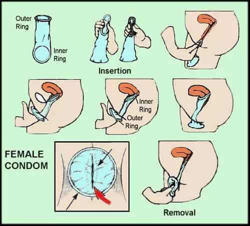 女生用的避孕套是什么样的丨科普