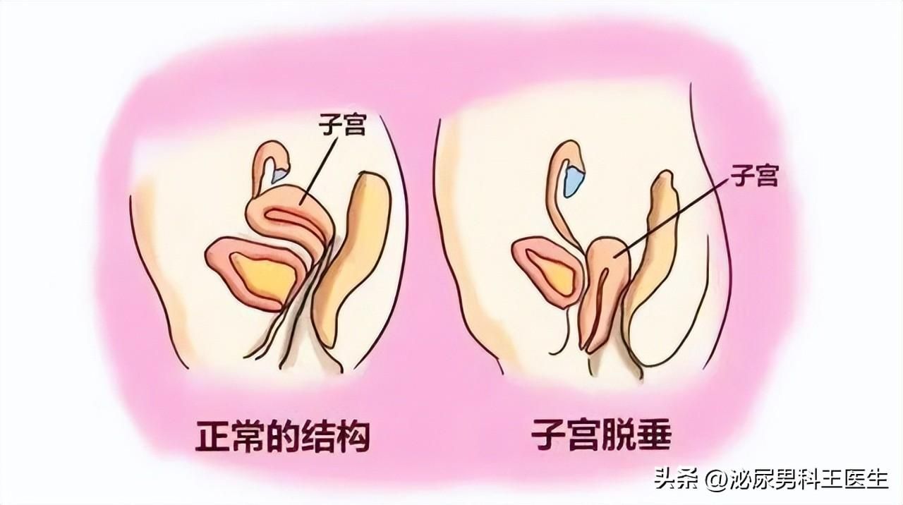 女子阴挺是什么情况 女性阴挺的原因和症状丨科普