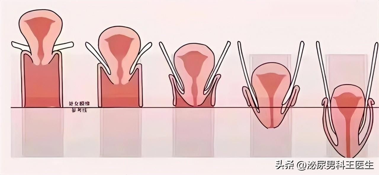 女子阴挺是什么情况 女性阴挺的原因和症状丨科普